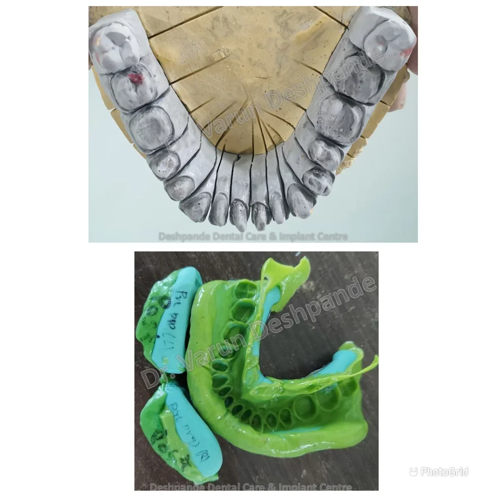Lower Arch Reconstruction with Zirconia Prosthesis - Image 5