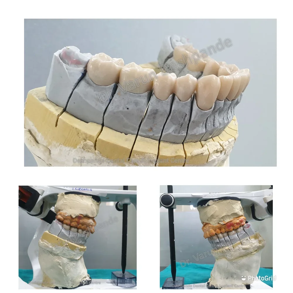 Lower Arch Reconstruction with Zirconia Prosthesis - Image 6