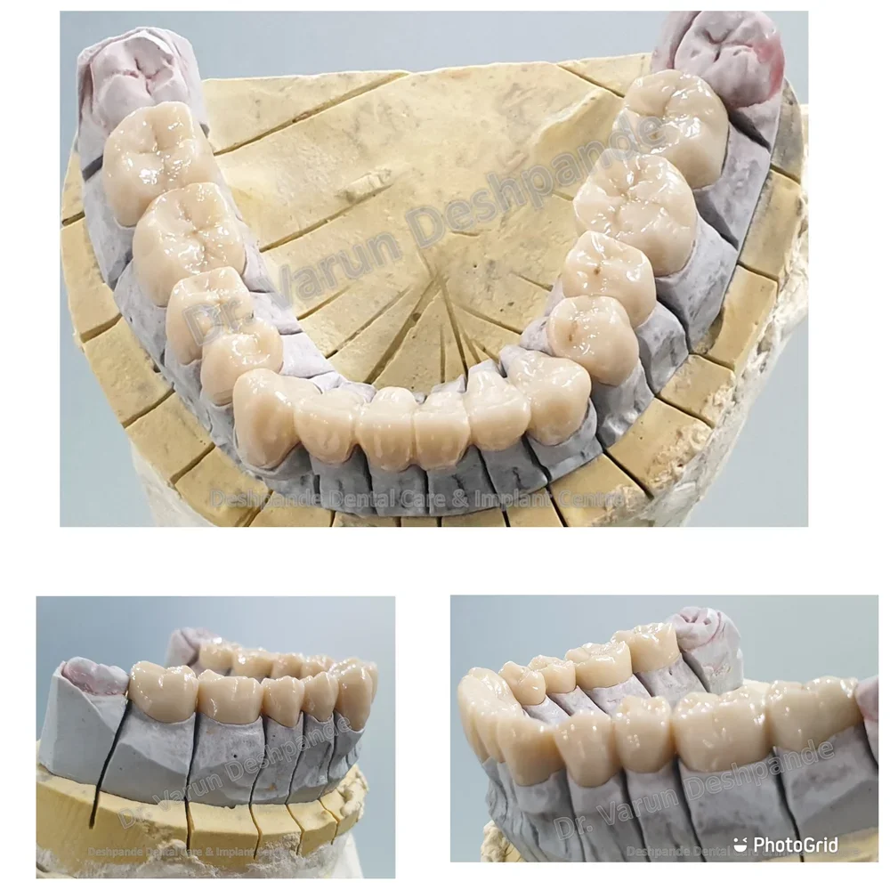 Lower Arch Reconstruction with Zirconia Prosthesis - Image 8