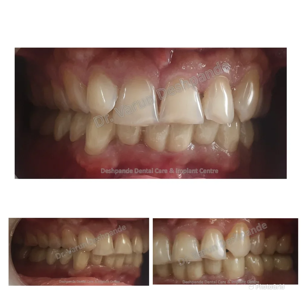 Lower Arch Reconstruction with Zirconia Prosthesis - Image 9