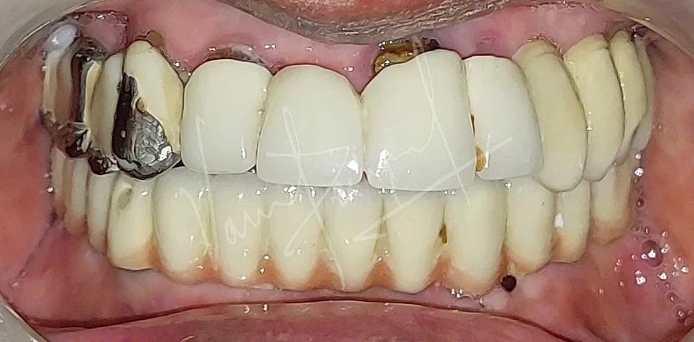 Mandibular Fixed Prosthesis using Dental Implants - Image 1