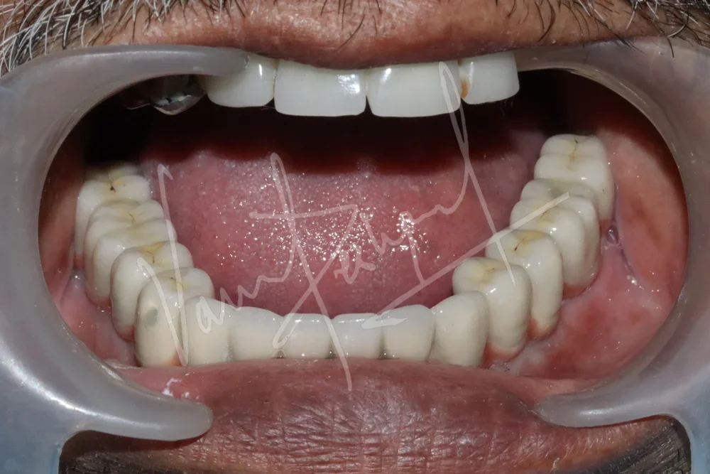 Mandibular Fixed Prosthesis using Dental Implants - Image 2