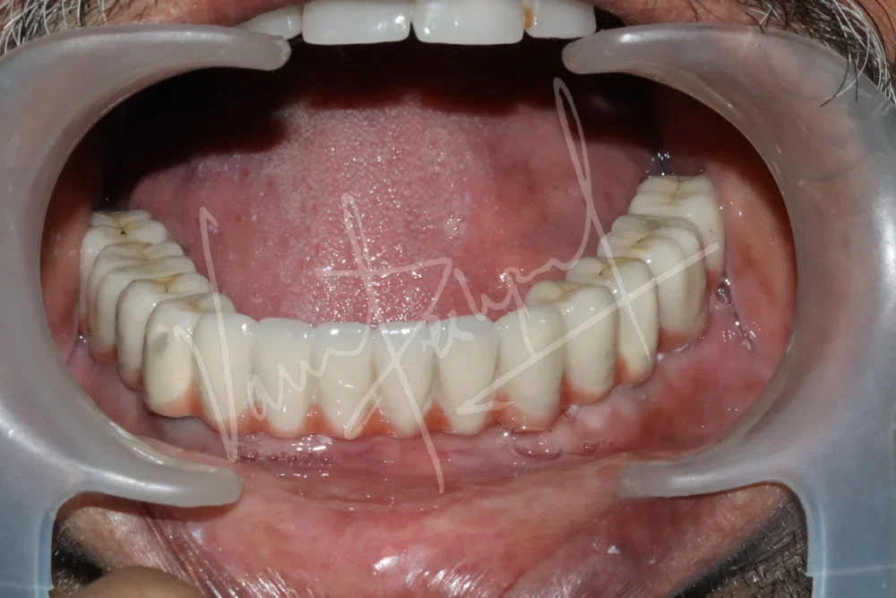 Mandibular Fixed Prosthesis using Dental Implants - Image 3