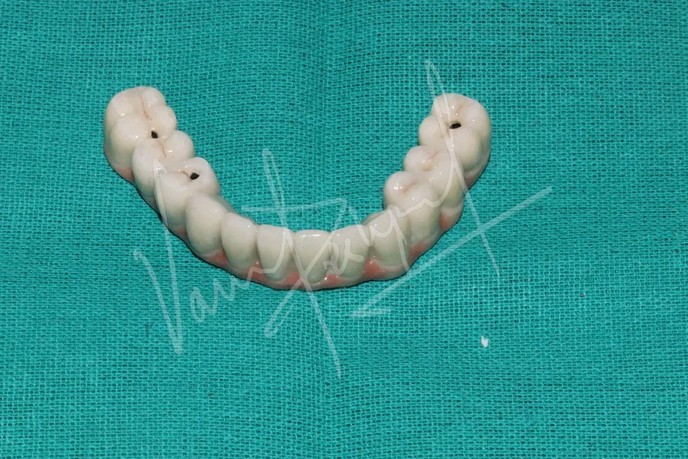 Mandibular Fixed Prosthesis using Dental Implants - Image 4