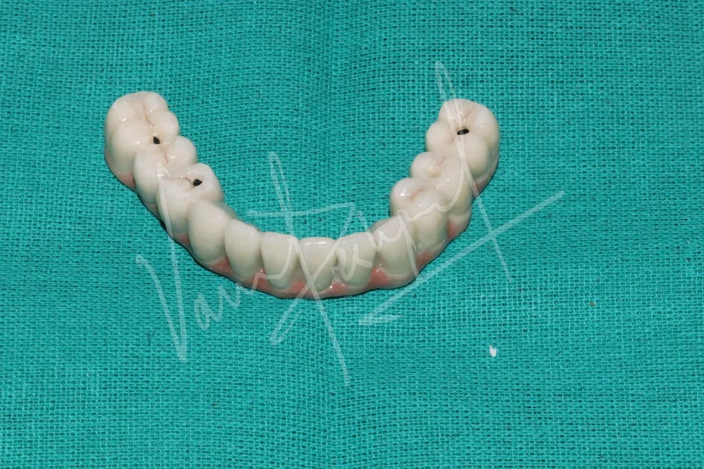 Mandibular Fixed Prosthesis using Dental Implants SB - Image 1