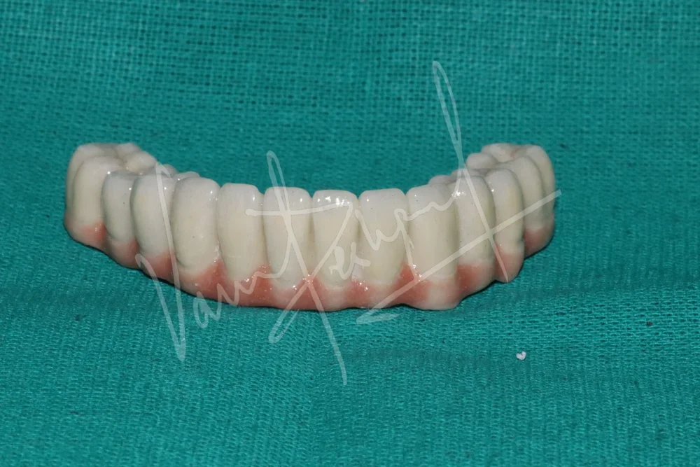 Mandibular Fixed Prosthesis using Dental Implants SB - Image 2