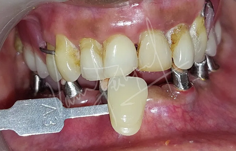 Mandibular Implant supported Fixed Prosthesis - Image 1