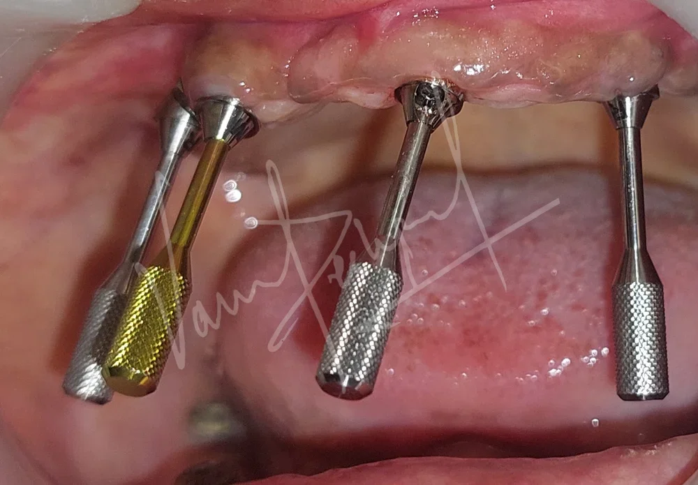 Maxillary and Mandibular All on 4 Implant Supported Prosthesis - Image 1