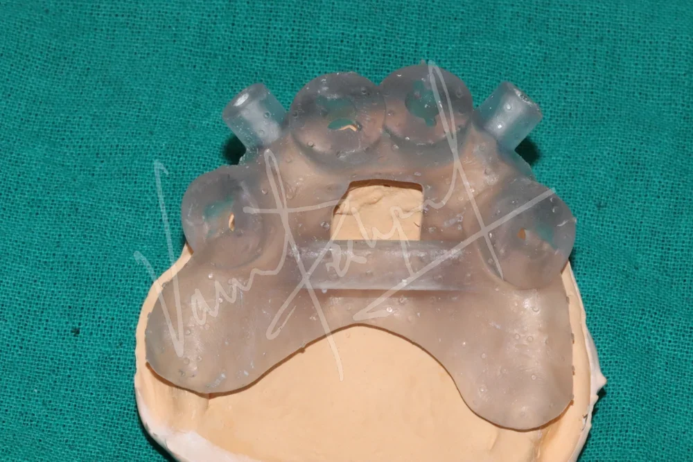 Maxillary and Mandibular All on 4 Implant Supported Prosthesis - Image 2