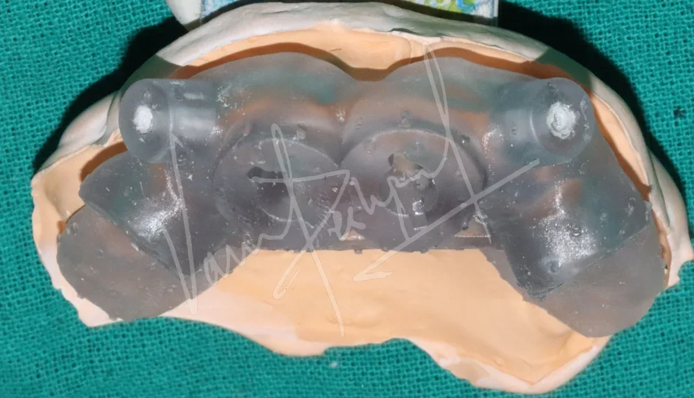 Maxillary and Mandibular All on 4 Implant Supported Prosthesis - Image 3