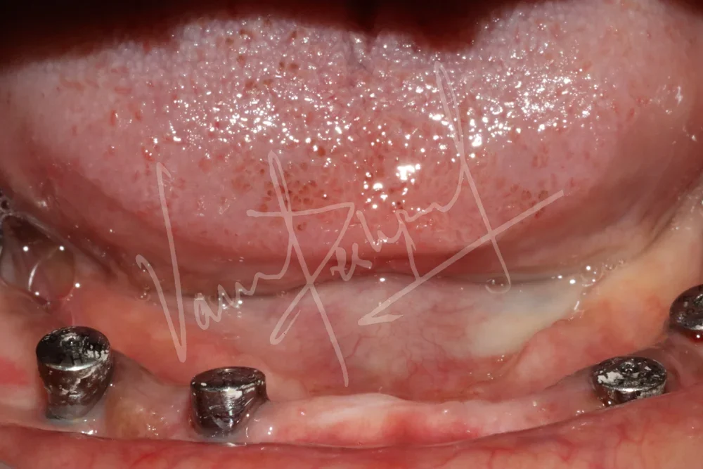 Maxillary and Mandibular All on 4 Implant Supported Prosthesis - Image 5
