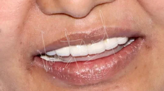 Maxillary and Mandibular All on 4 Implant Supported Prosthesis - Image 6