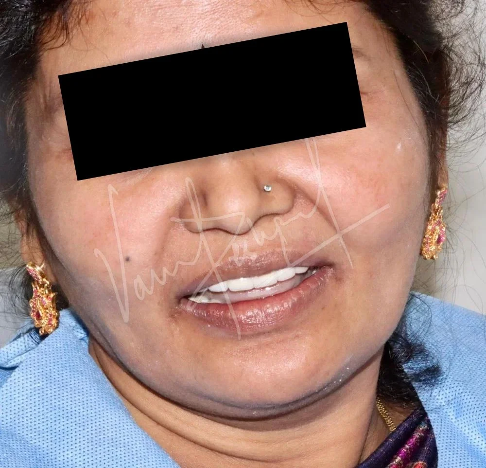 Maxillary and Mandibular All on 4 Implant Supported Prosthesis - Image 7