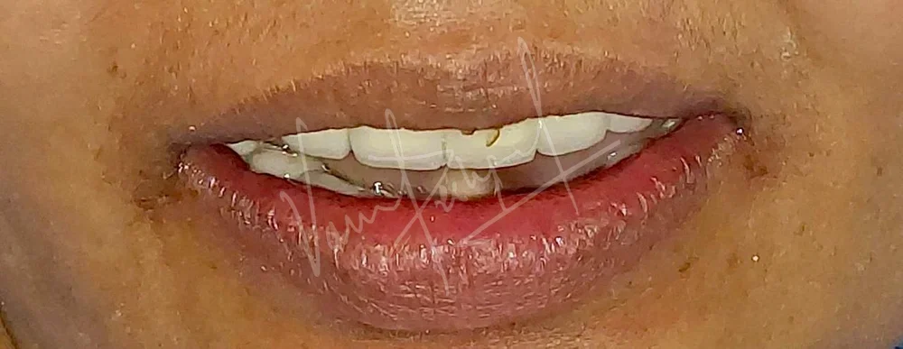 Maxillary and Mandibular All on 4 Implant Supported Prosthesis - Image 8