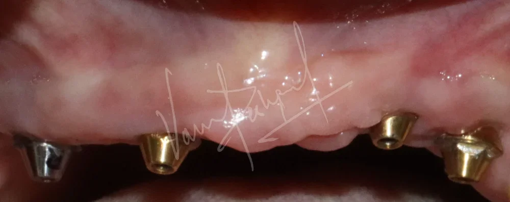 Maxillary and Mandibular Implant supported Fixed Prosthesis - Image 1