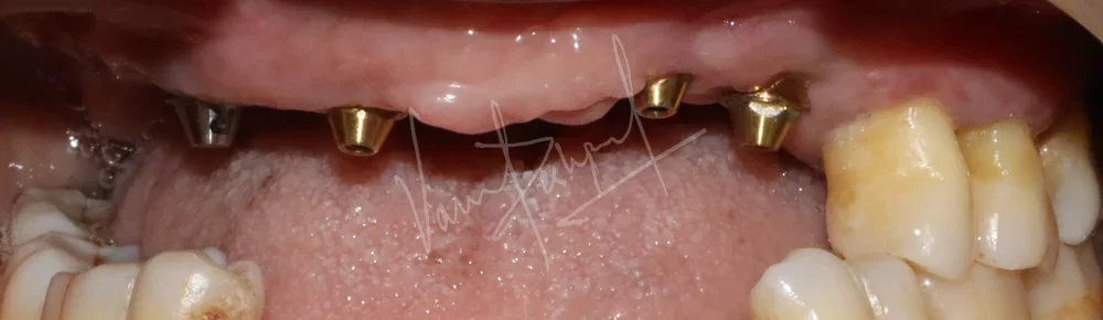 Maxillary and Mandibular Implant supported Fixed Prosthesis - Image 2
