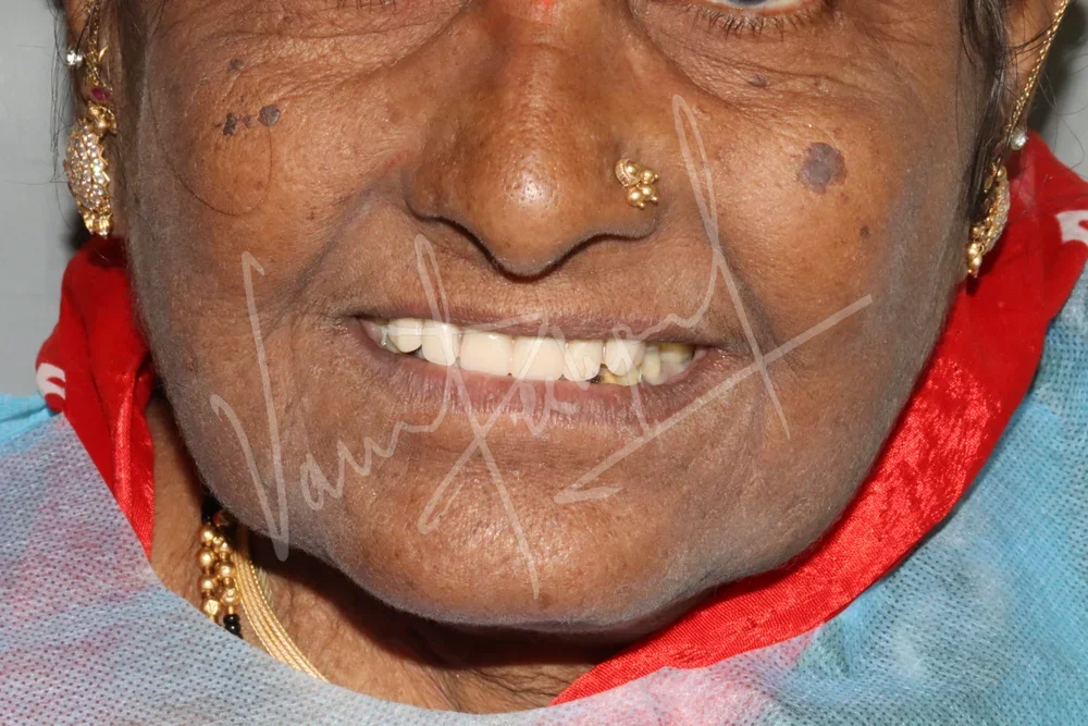 Maxillary and Mandibular Implant supported Fixed Prosthesis - Image 8