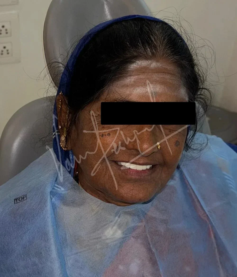 Maxillary and Mandibular Implant supported Fixed Prosthesis - Image 9