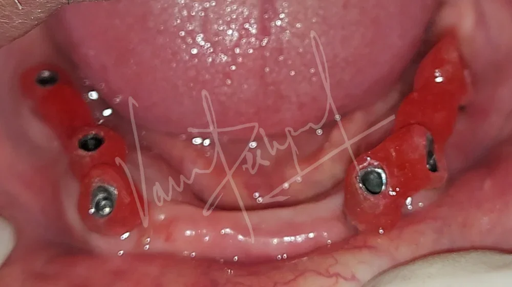 Maxillary Complete Denture and Mandibular Implant supported Fixed Prosthesis - Image 1