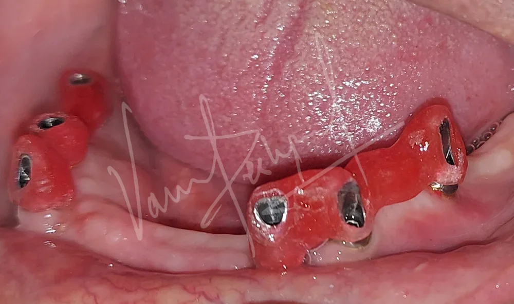 Maxillary Complete Denture and Mandibular Implant supported Fixed Prosthesis - Image 2