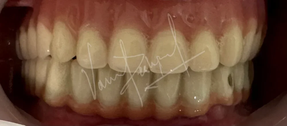 Maxillary Complete Denture and Mandibular Implant supported Fixed Prosthesis - Image 3