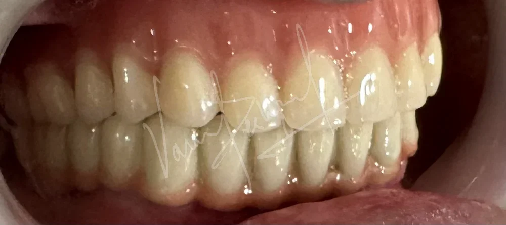 Maxillary Complete Denture and Mandibular Implant supported Fixed Prosthesis - Image 4