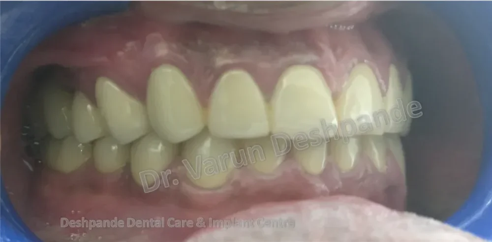 One Year Follow up of FMR case with Metal Ceramic Prosthesis - Image 2
