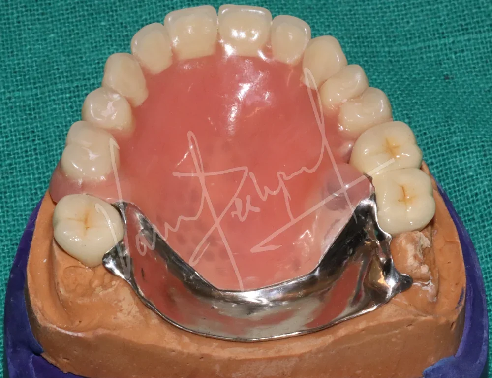 Prosthetic Rehabilitation of Maxillary defect using Obturator and Precision Attachment - Image 12