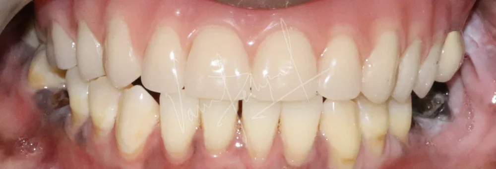 Prosthetic Rehabilitation of Maxillary defect using Obturator and Precision Attachment - Image 14