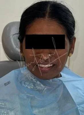 Prosthetic Rehabilitation of Maxillary defect using Obturator and Precision Attachment - Image 16