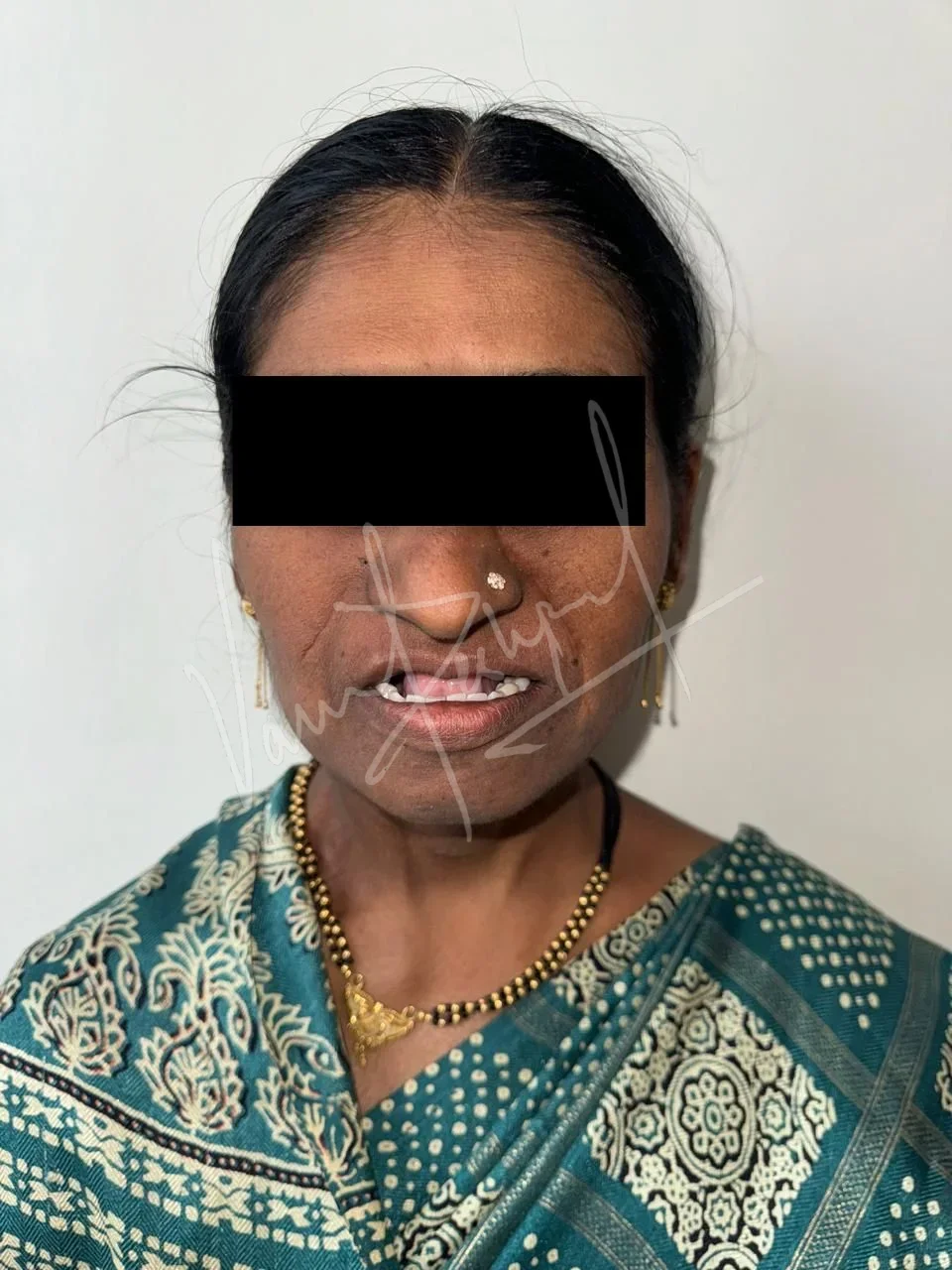 Prosthetic Rehabilitation of Maxillary defect using Obturator and Precision Attachment - Image 17