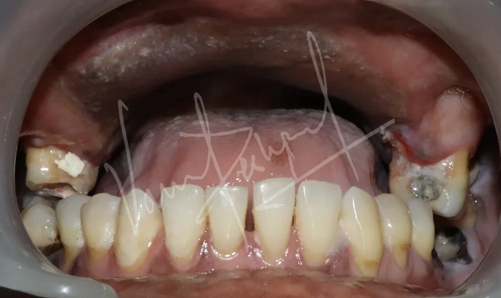 Prosthetic Rehabilitation of Maxillary defect using Obturator and Precision Attachment - Image 2