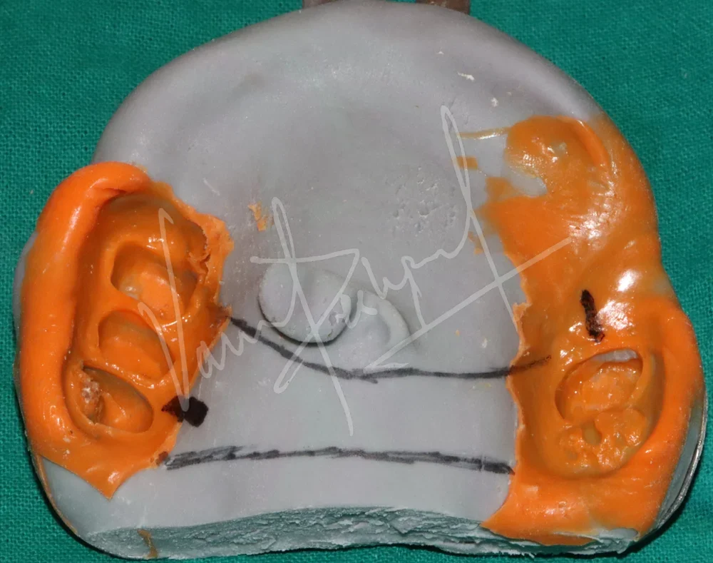 Prosthetic Rehabilitation of Maxillary defect using Obturator and Precision Attachment - Image 6