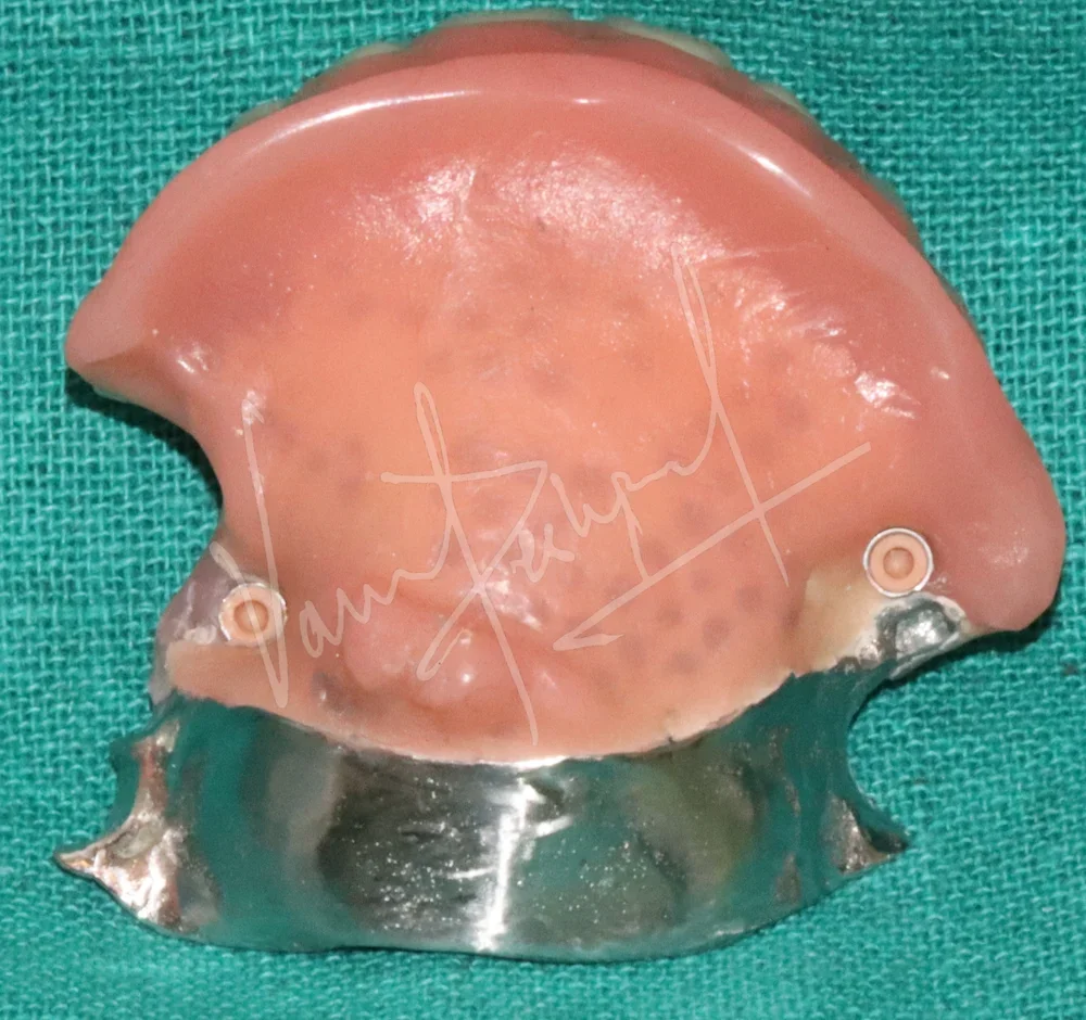 Prosthetic Rehabilitation of Maxillary defect using Obturator and Precision Attachment - Image 8