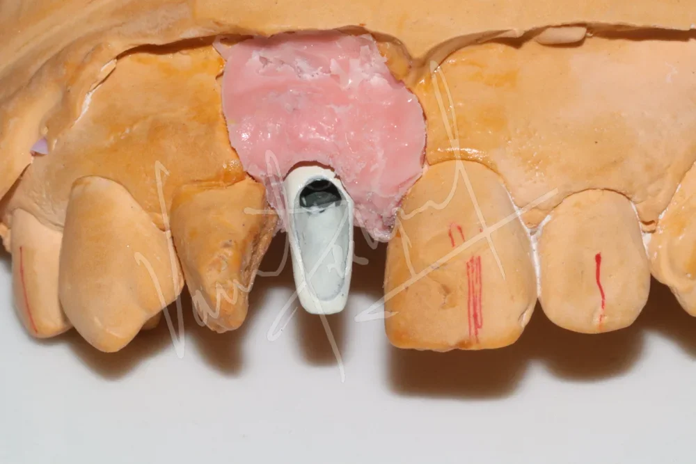 Replacing Anterior Single Tooth with Dental Implant - Image 1