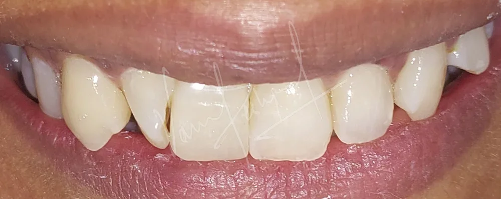 Replacing Anterior Single Tooth with Dental Implant - Image 4