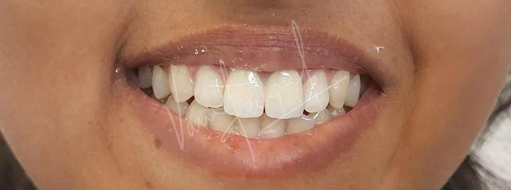 Restoring Anterior Fractured Teeth with All Ceramic Prosthesis - Image 4