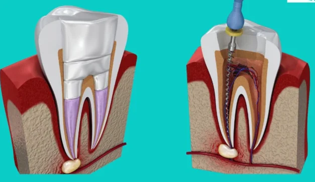 Root Canal vs Filling
