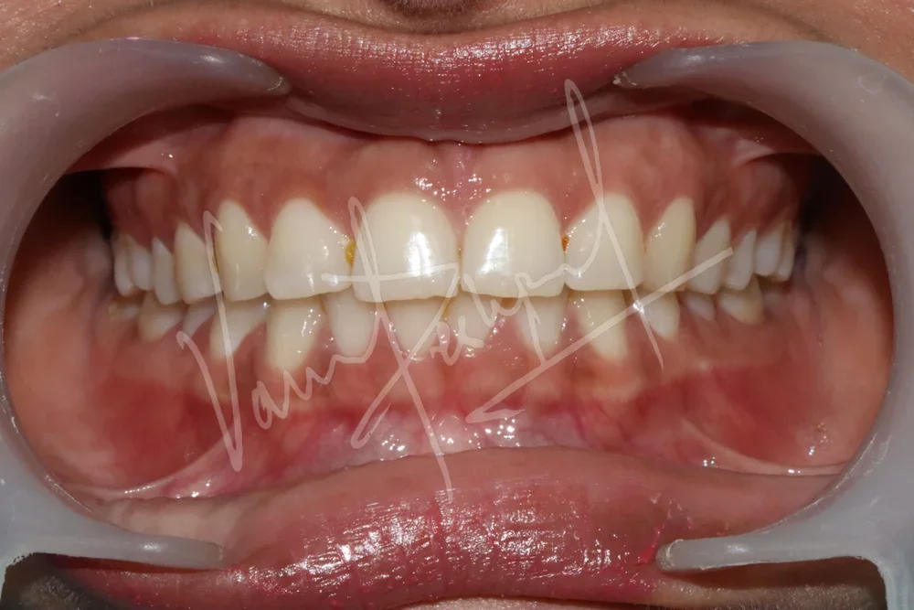 Zoom Teeth Whitening - Image 1