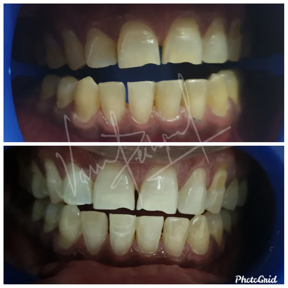 Zoom Teeth Whitening - Image 10