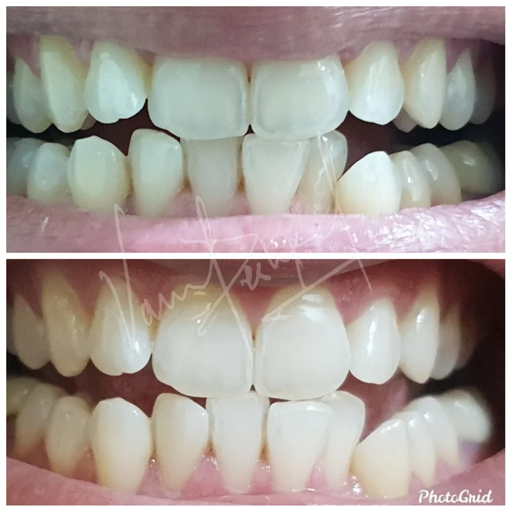 Zoom Teeth Whitening - Image 11