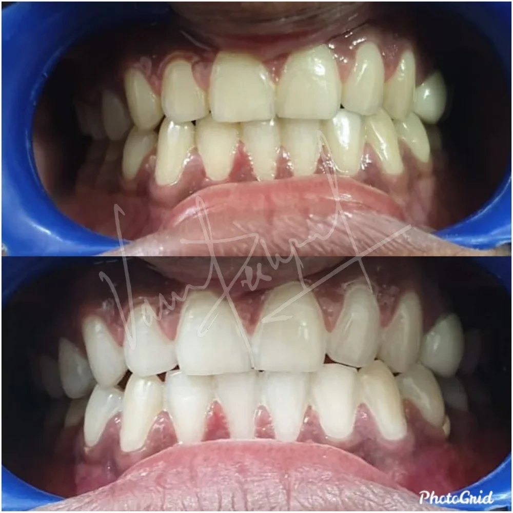 Zoom Teeth Whitening - Image 13