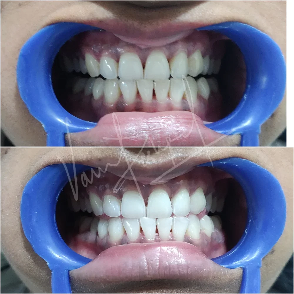 Zoom Teeth Whitening - Image 14
