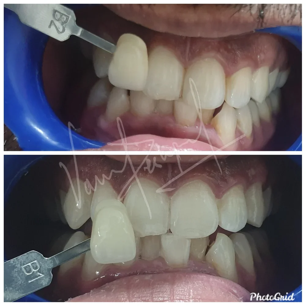 Zoom Teeth Whitening - Image 7