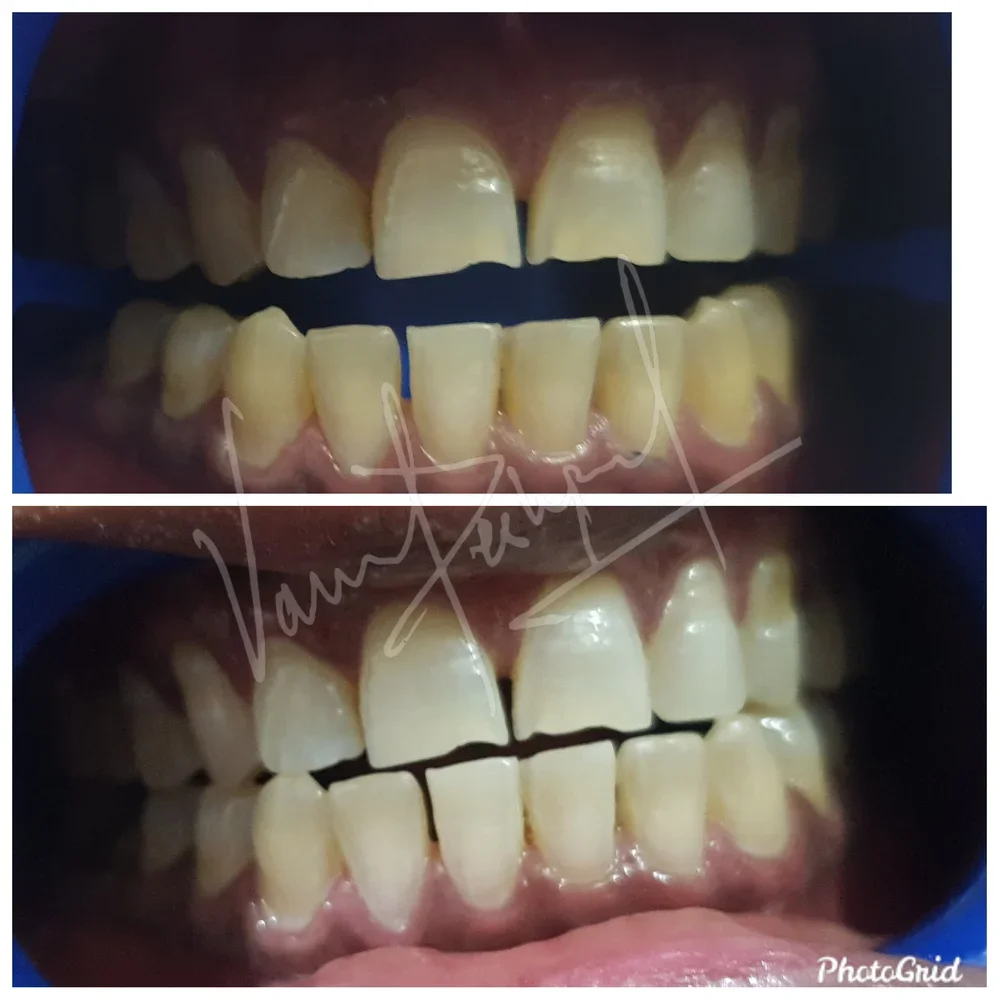 Zoom Teeth Whitening - Image 9